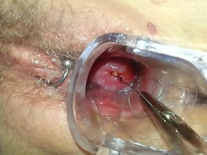 Mirena Spirale ziehen हटाने आईयूडी IUP entfernen